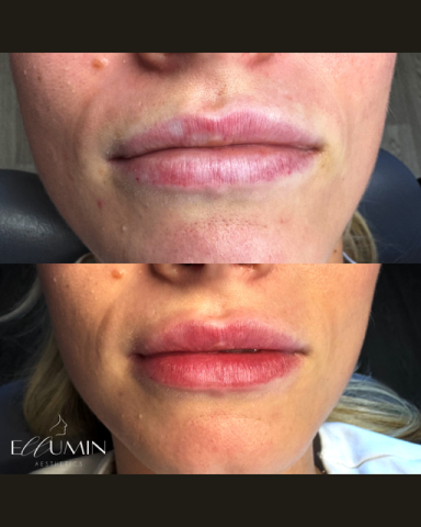 Lip Enhancement