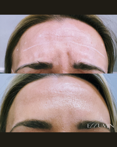 Anti-Wrinkle Treatment