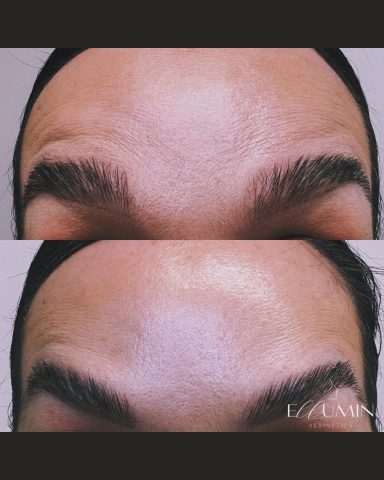 Anti-Wrinkle Treatment