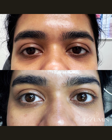 Polynucleotide Treatment Eyes
