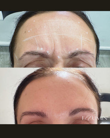 Anti-wrinkle Treatment