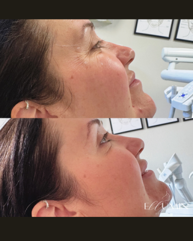 Anti-wrinkle Treatment