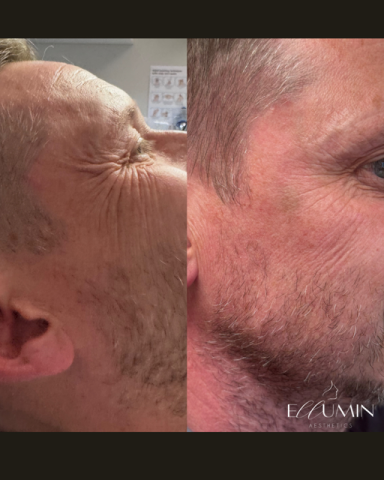Anti-wrinkle Treatment