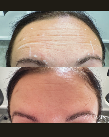 Anti-wrinkle Treatment