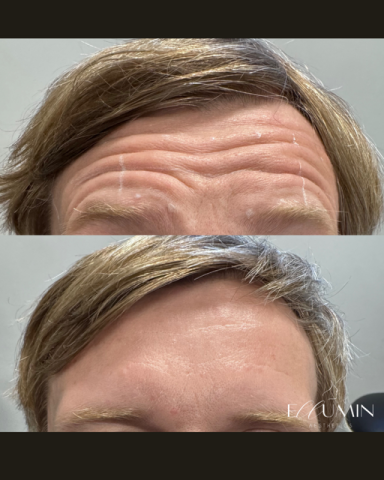 Anti-wrinkle Treatment