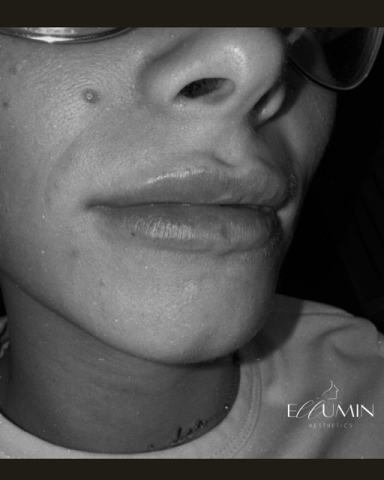 Lip Enhancement