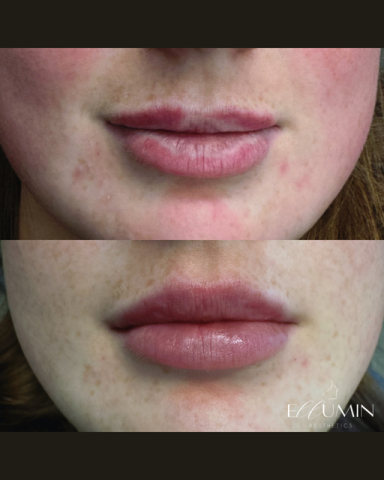 Lip Enhancement